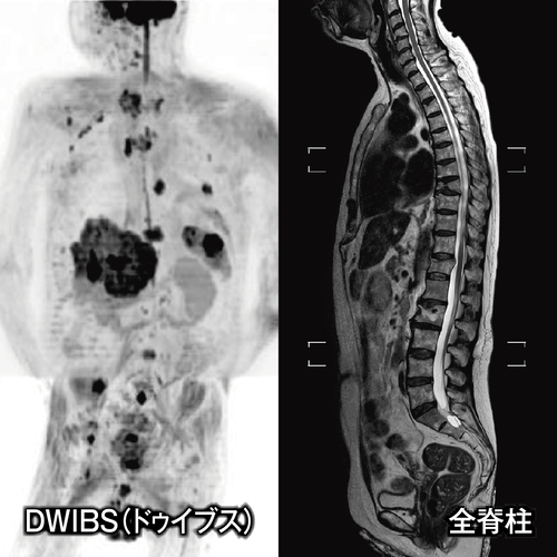 DWIBS・全脊柱の画像