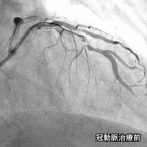 冠動脈治療前の画像