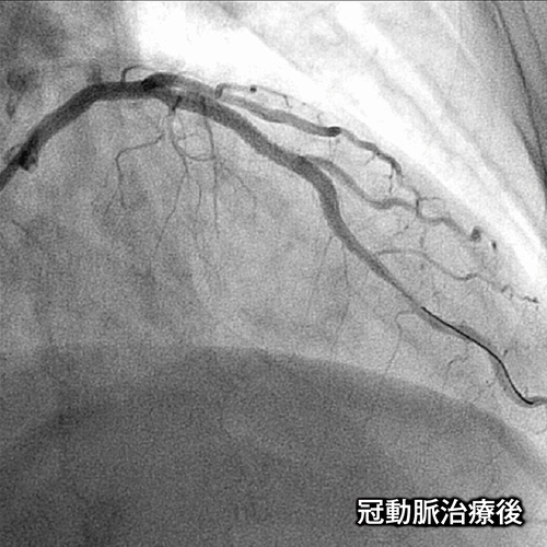 冠動脈治療後の画像