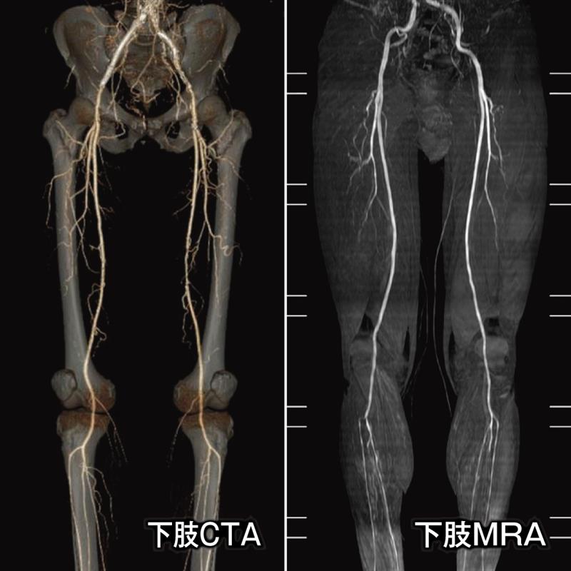 下肢CTAの画像