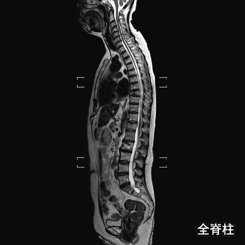 DWIBS・全脊柱の画像